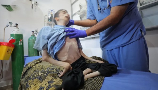 İsrail'in kıtlığı dayattığı Gazze'de felçli genç yetersiz beslenmeden hayatını kaybetti