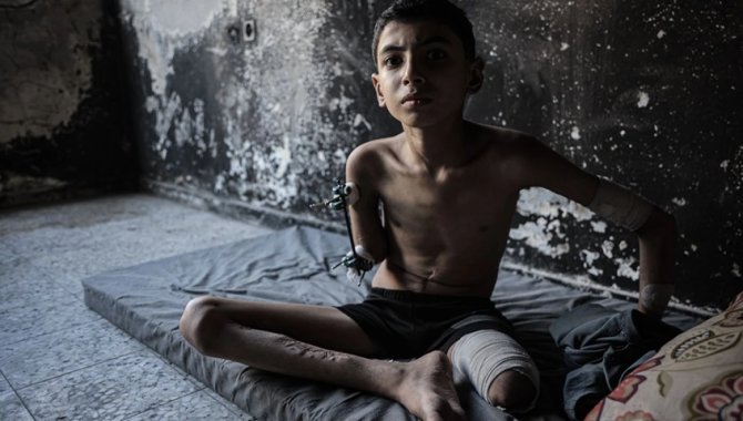 İsrail'in saldırısında kol ve bacağını kaybeden Semir, eskisi gibi futbol oynamak istiyor