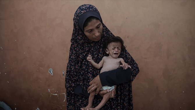 Gazze'de yetersiz beslenme sorunu yaşayan 5 aylık bebeğin annesi çocuğunun ölmesinden korkuyor