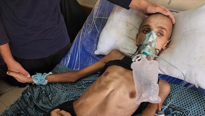 Gazze'de yardım almaya giderken başından vurularak felç kalan 16 yaşındaki Muhenned adeta "iskelete" dönüştü