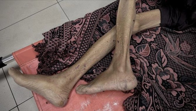 İsrail saldırıları altındaki Gazze’de son 3 haftada bin yetişkin yetersiz beslenme nedeniyle hastaneye başvurdu