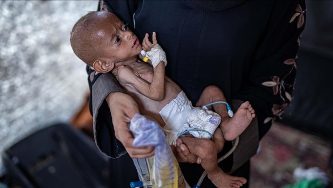 Yetersiz beslenme kaynaklı can kayıplarının arttığı Gazze'de hastanelerdeki çocuklar adeta ölümü bekliyor