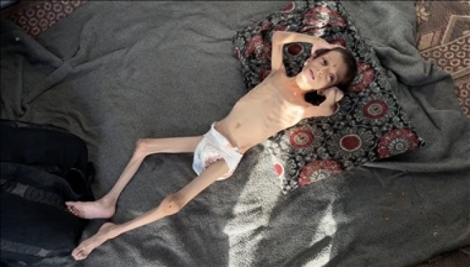 İsrail'in kıtlığa sürüklediği Gazze'de "beyin atrofisi" hastası 10 yaşındaki Nafız kemik yığınına dönüştü