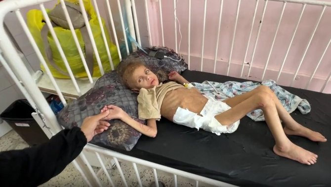 DSÖ, Gazze'de son 2 ayda 10 bin çocuğa akut yetersiz beslenme teşhisi konulduğunu bildirdi