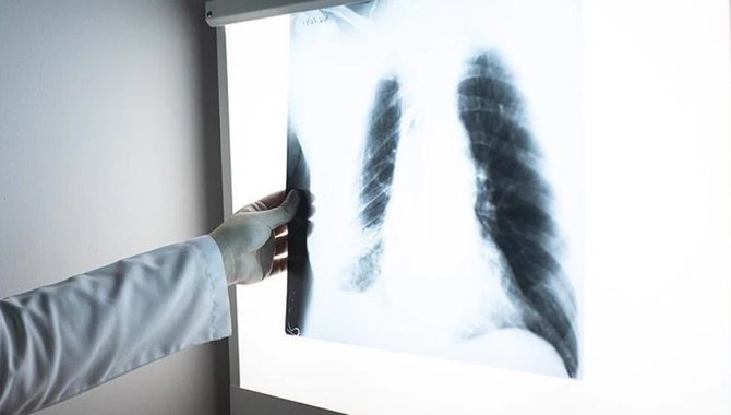 DSÖ: 2024'te 1,2 milyondan fazla kişi tüberküloz nedeniyle öldü