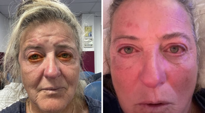Gözlerini Kaybetme Noktasına Geldi: Kirli Elle Takılan Kontakt Lens Kabusu Yaşattı