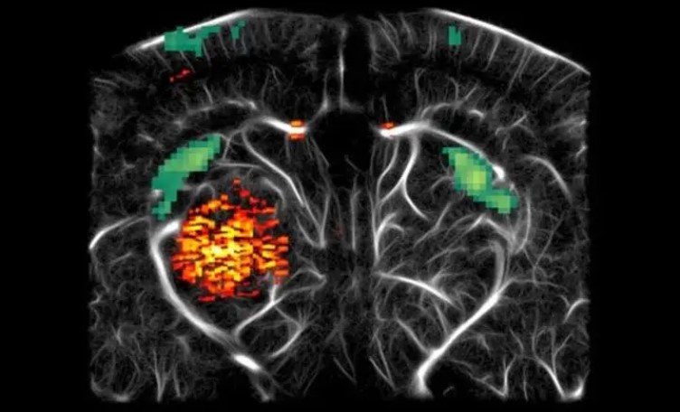 Glioblastom Tümörünün Beyindeki Yayılımı Yeni Ultrason Tekniğiyle Canlı Görüntülendi