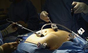 Göbekten Obezite Ameliyatı