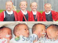 10 milyonda bir görülen çift ikiz bebekler