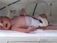 Yeni doğan bebeğin karnından 1 kilo 300 gram kitle çıkarıldı