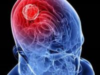'Beyin tümörlerinde erken teşhis önemli'
