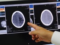 'Beyin damarındaki tıkanıklıkta 'stent' hayat kurtarıyor
