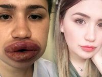 Kuaföre dudak dolgusu yaptıran Merve Keleş'in doktoru: Dünyada görülmemiş bir vaka