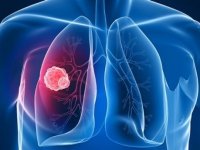 Akciğer kanserinde "kombine tedavi"