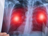 Hava kirliliği akciğer kanseri riskini arttırıyor