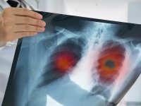 Akciğer Kanserinde En Sık Görülen Kanser Türü