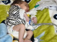 Kalpten çıkan iki ana damarı ters olarak doğan bebek, 53 günlük yaşam savaşını kazandı