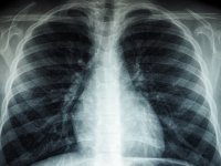 Kovid-19 akciğer katılaşmasına neden olabiliyor