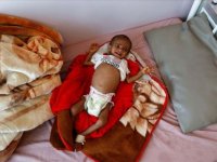 Yemen'de 13 yaşındaki çocuk akut yetersiz beslenme nedeniyle yaşam mücadelesi veriyor