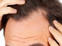 Kök Hücre Tedavisi İle Saç Dökülmesini Durdurun