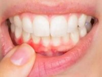 Diş eti hastalıkları yetişkinlerdeki diş kayıplarının en önemli nedeni olarak görülüyor