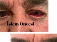 Elmalı Devlet Hastanesi’nde Göz Kapağı Estetik Ameliyatları Başladı