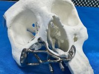 Çene kemiği erimiş hastalara özel titanyum diş implantı