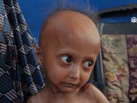 Gazze'de "Skleroderma" hastası 4 yaşındaki Hala, tedavi olamadığı için "yavaş yavaş" ölüyor