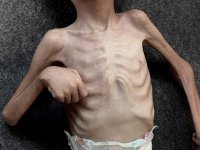 Gazze’de yetersiz beslenmeden ölen çocuklar insani krizin en acı yüzü oldu