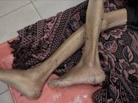 İsrail saldırıları altındaki Gazze’de son 3 haftada bin yetişkin yetersiz beslenme nedeniyle hastaneye başvurdu