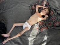 İsrail'in kıtlığa sürüklediği Gazze'de "beyin atrofisi" hastası 10 yaşındaki Nafız kemik yığınına dönüştü