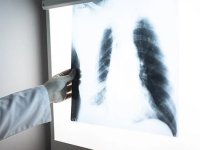 DSÖ: 2024'te 1,2 milyondan fazla kişi tüberküloz nedeniyle öldü