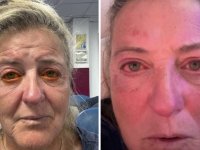 Gözlerini Kaybetme Noktasına Geldi: Kirli Elle Takılan Kontakt Lens Kabusu Yaşattı