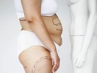 Liposuction yaptıracaklara uzmanından tavsiyeler