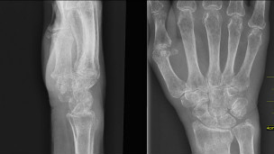 Osteoporoz ancak kemiklerin zayıflayarak kırılmasıyla teşhis edilebiliyor