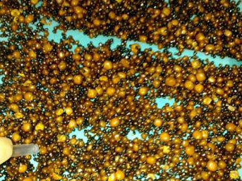 Safra kesesinden 8 bin 422 taş çıktı