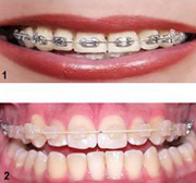 Ortodonti hangi yaşlarda uygulanabilir?